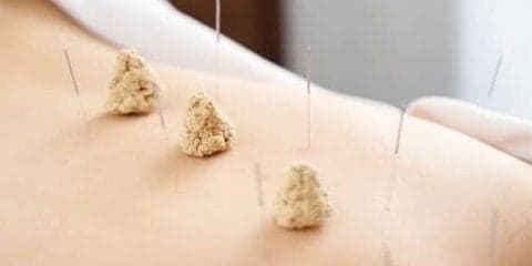 科学的に検証された「鍼灸治療」の効果とは？
